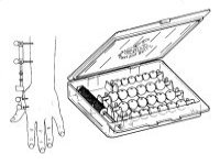 X-Series for capping external fixator and large pins